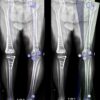 Estudo Científico – Artroplastia Total do Joelho em Osteoartrite