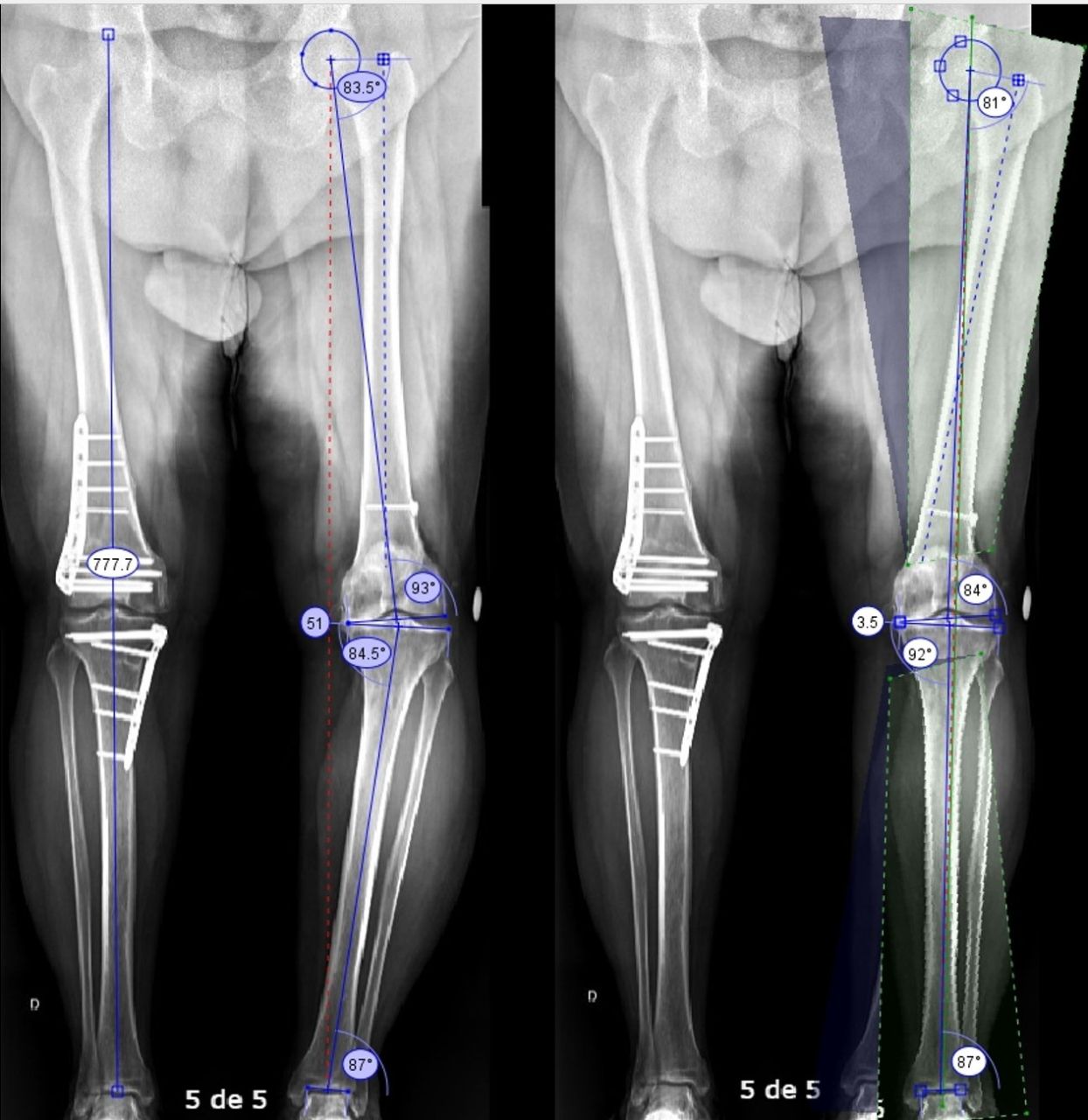 Estudo Científico – Artroplastia Total do Joelho em Osteoartrite