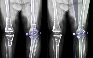 Estudo Científico – Artroplastia Total do Joelho em Osteoartrite